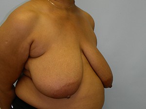 Breast Reduction before and after - before