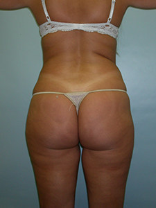 Liposuction before and after - before