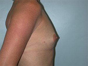 Breast Augmentation before and after - before
