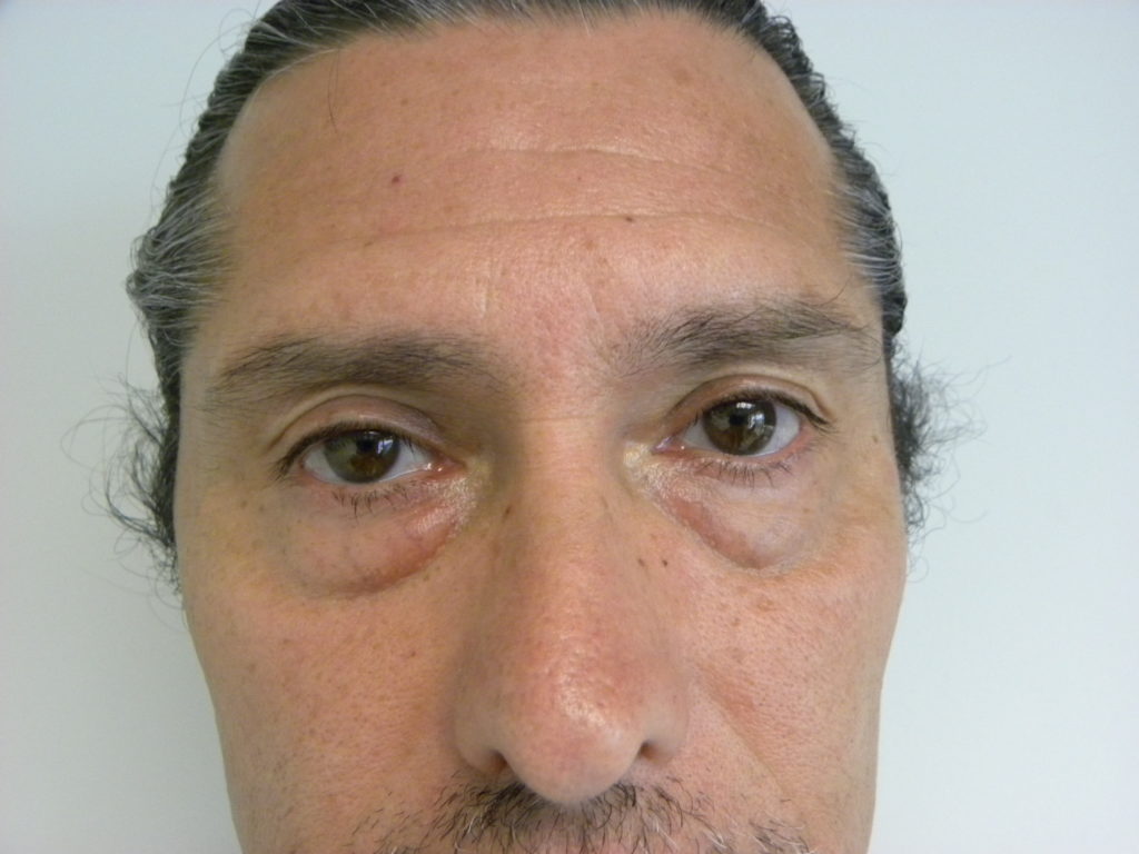 Blepharoplasty before and after - before