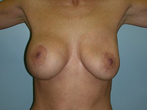 Breast Augmentation before and after - before