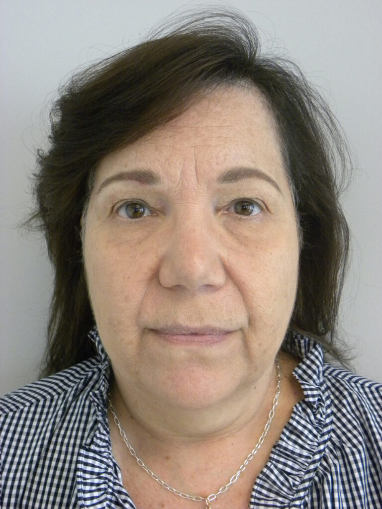 Blepharoplasty before and after - before