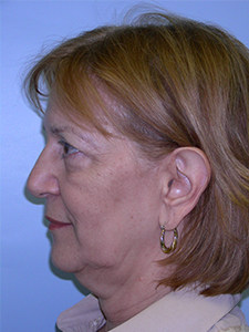 Facelift before and after - before