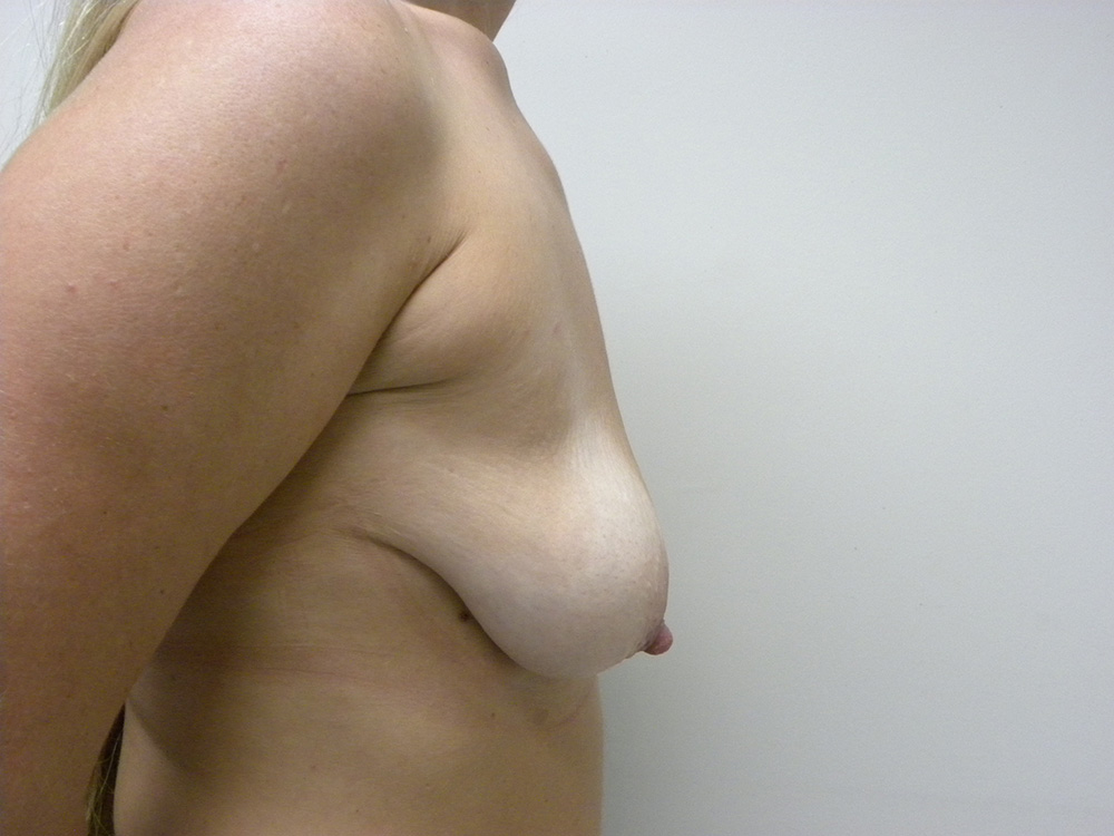 Breast Lift before and after - before