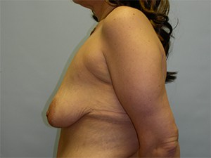 Breast Lift before and after - before