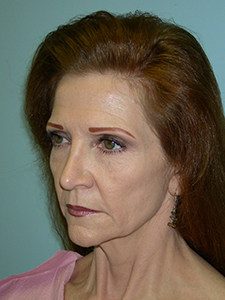 Facelift before and after - before