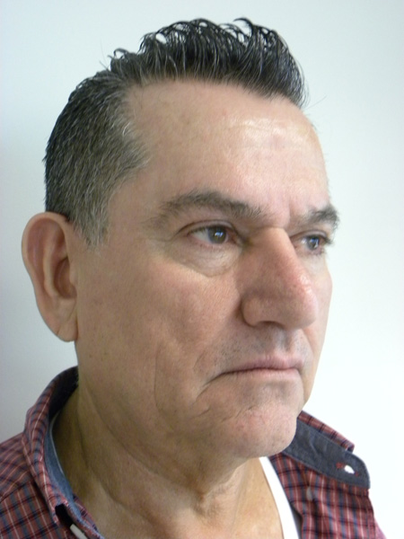 Facelift before and after - before