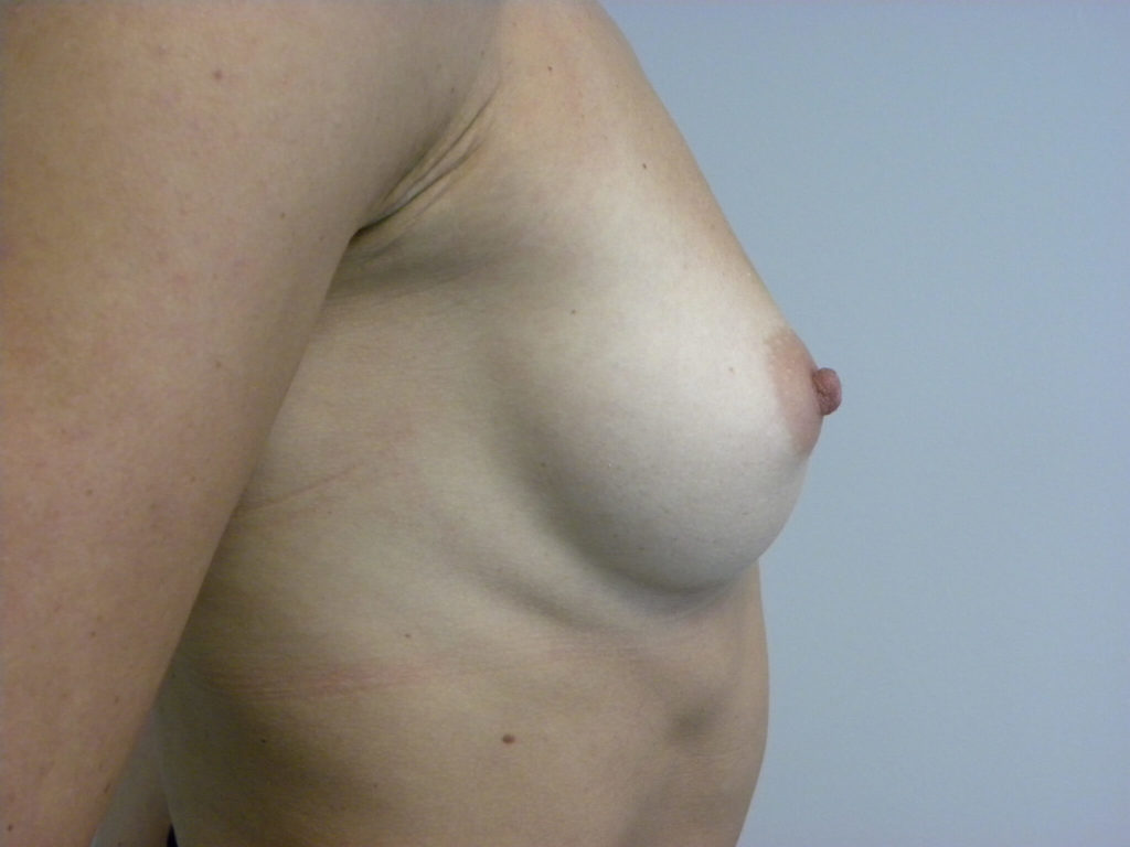 Breast Augmentation before and after - before