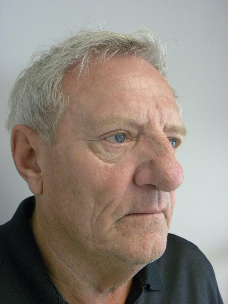 Facelift before and after - before