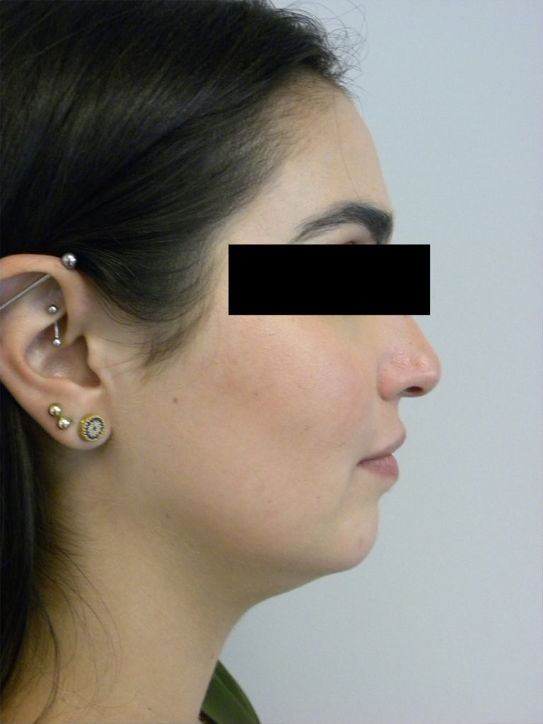 Chin before and after - before
