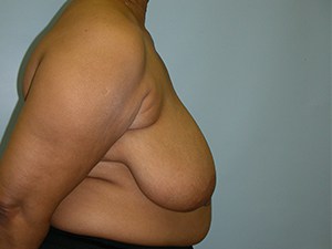 Breast Reduction before and after - before