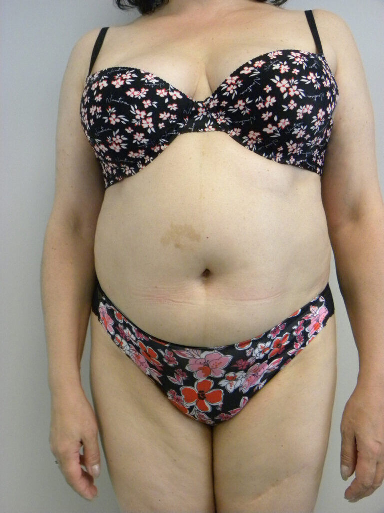 Liposuction before and after - before