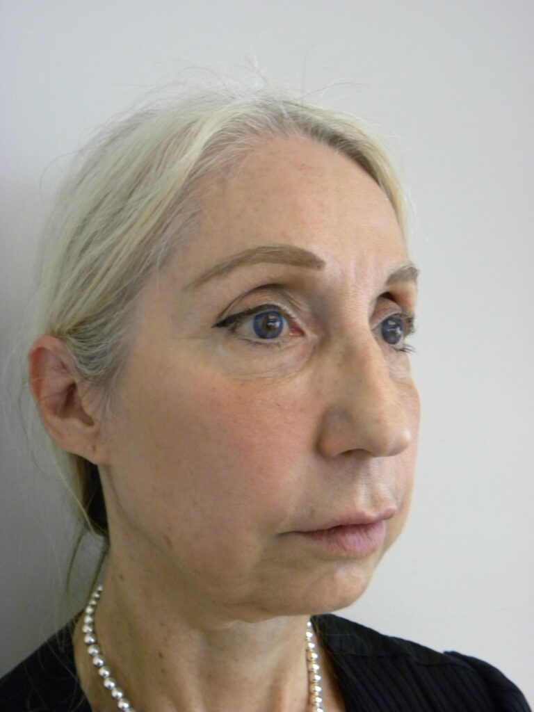 Facelift before and after - before