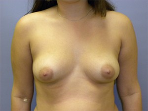 Breast Augmentation before and after - before