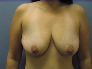 Breast Lift before and after - before