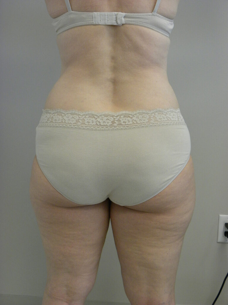 Liposuction before and after - before