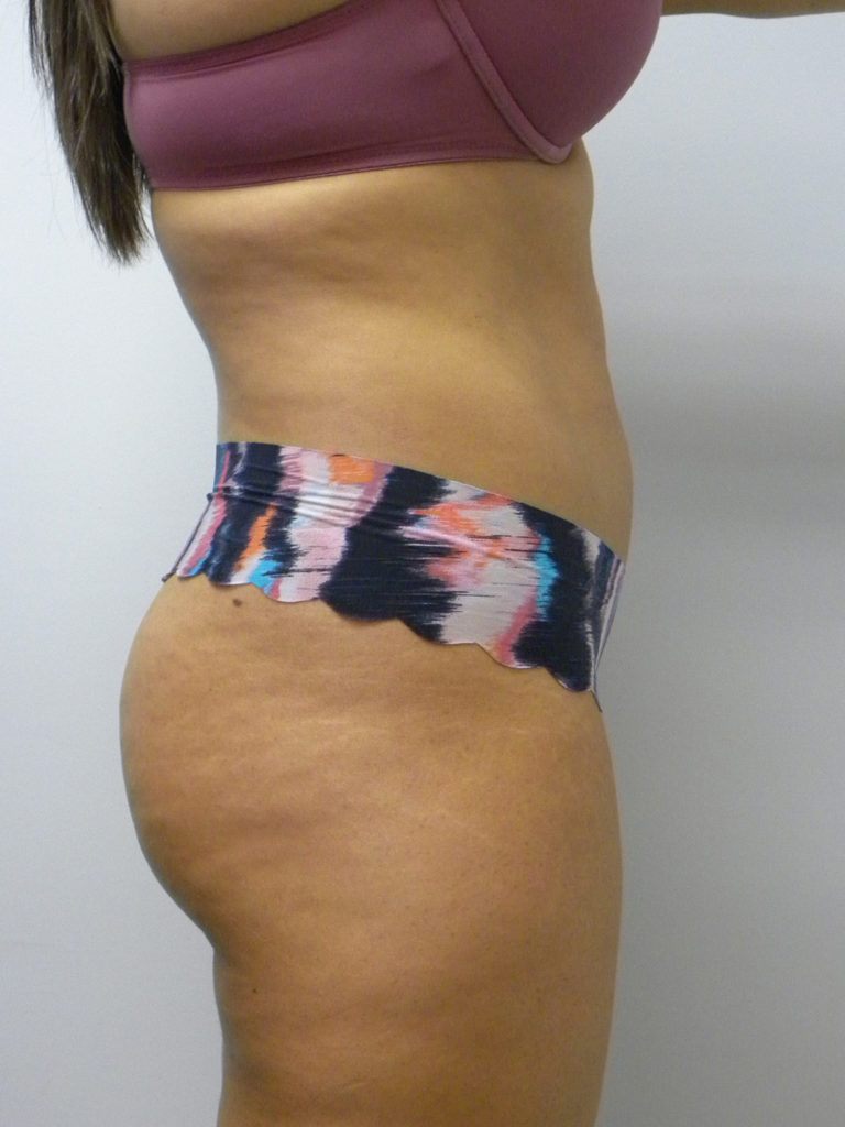 Liposuction before and after - before