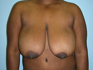 Breast Reduction before and after - before