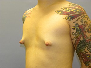 Breast Augmentation before and after - before