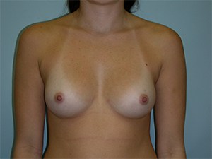 Breast Augmentation before and after - before