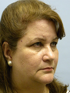 Facelift before and after - before