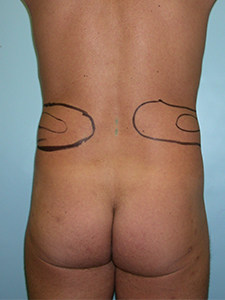 Liposuction before and after - before