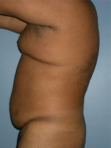 Liposuction before and after - before