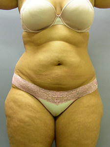 Liposuction before and after - before
