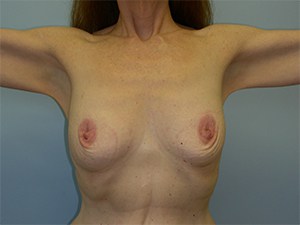 Breast Augmentation before and after - before