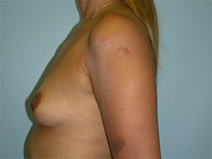 Breast Augmentation before and after - before
