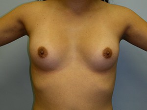 Breast Augmentation before and after - before