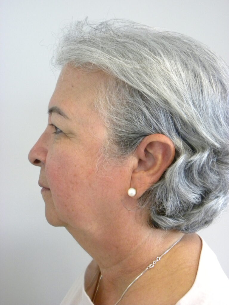 Blepharoplasty before and after - before