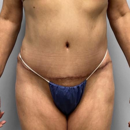 Tummy Tuck, Lipo, & BBL before and after - after