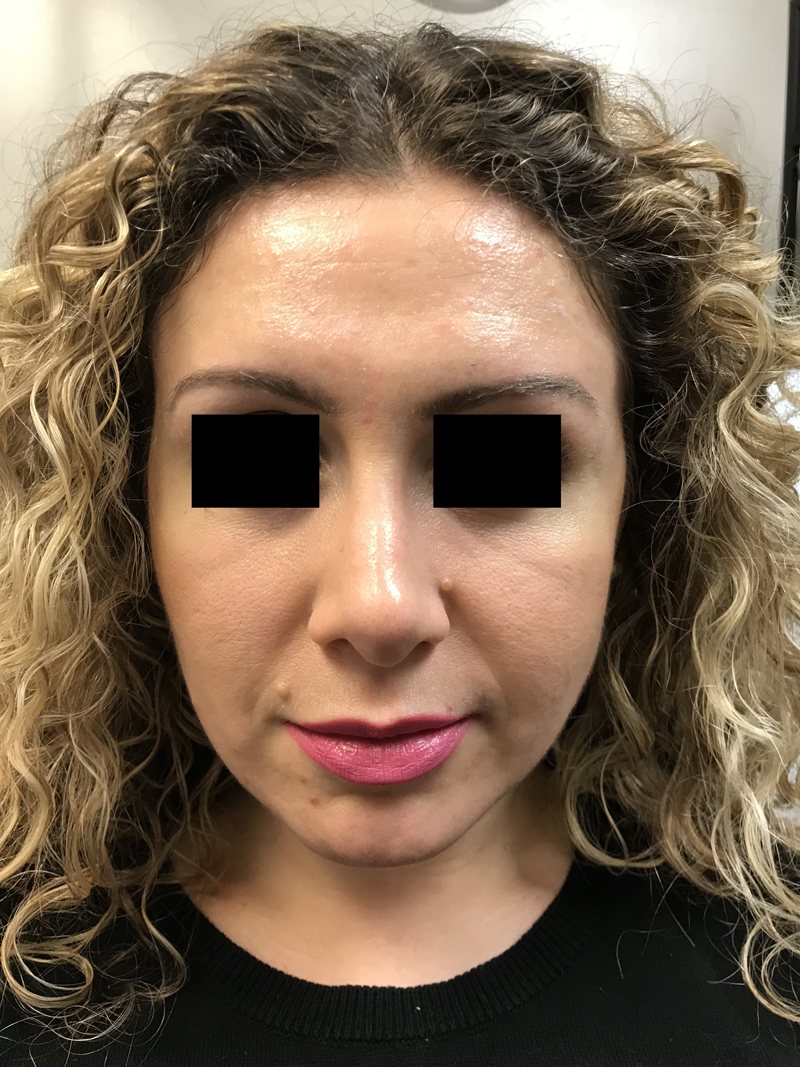 Rhinoplasty before and after - after