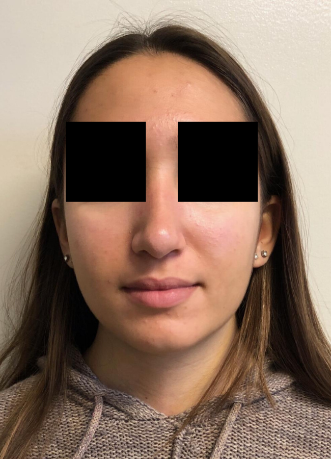 Rhinoplasty before and after - after