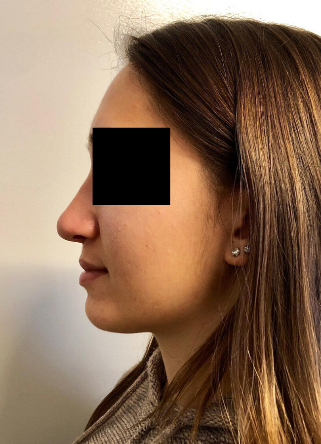 Rhinoplasty before and after - after