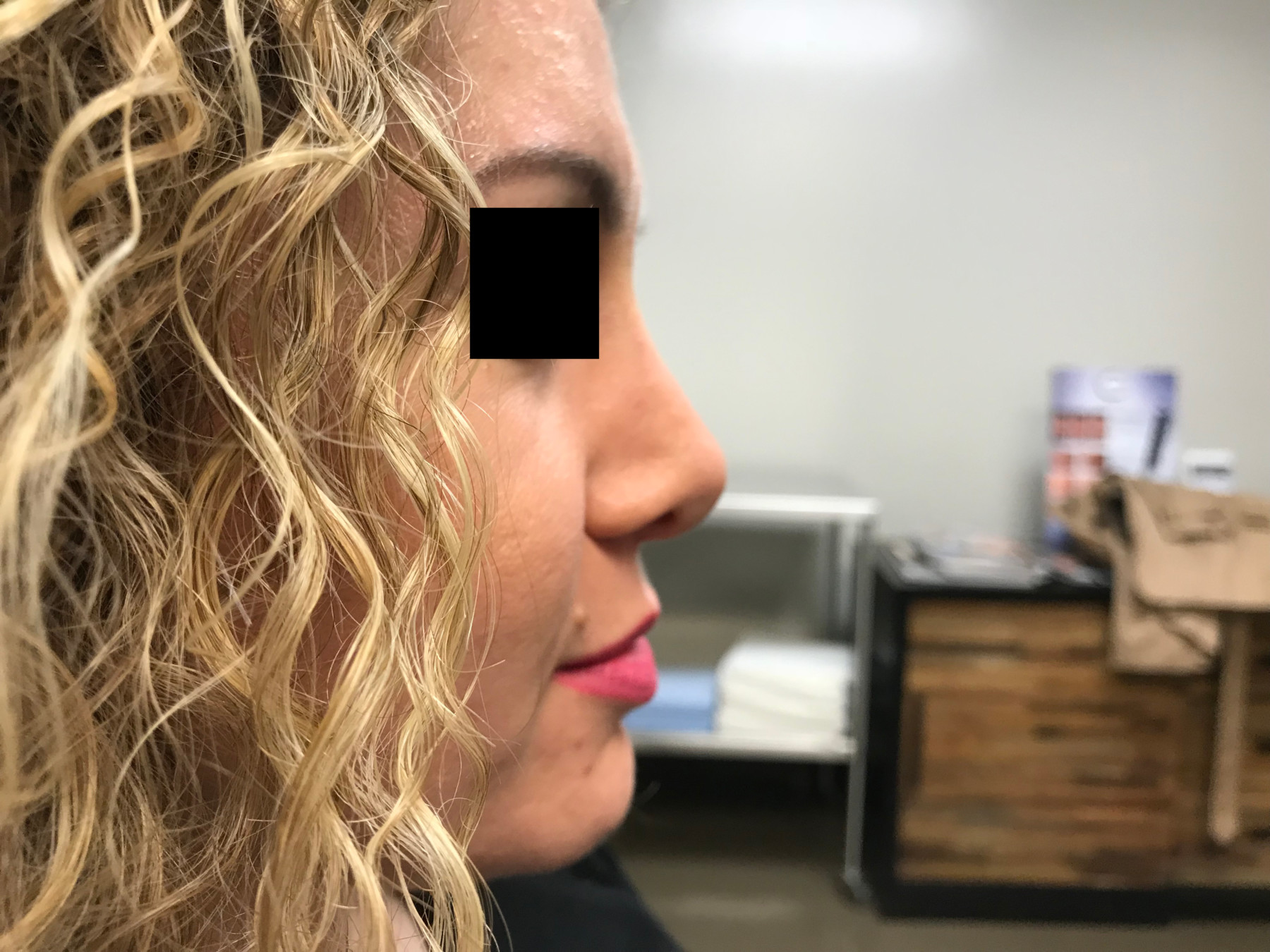 Rhinoplasty before and after - after