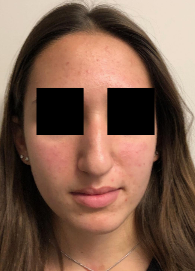 Rhinoplasty before and after - before