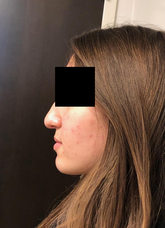 Rhinoplasty before and after - before
