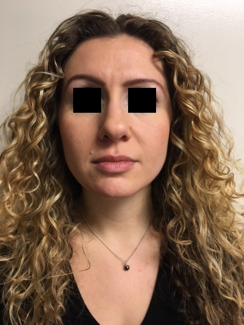 Rhinoplasty before and after - before