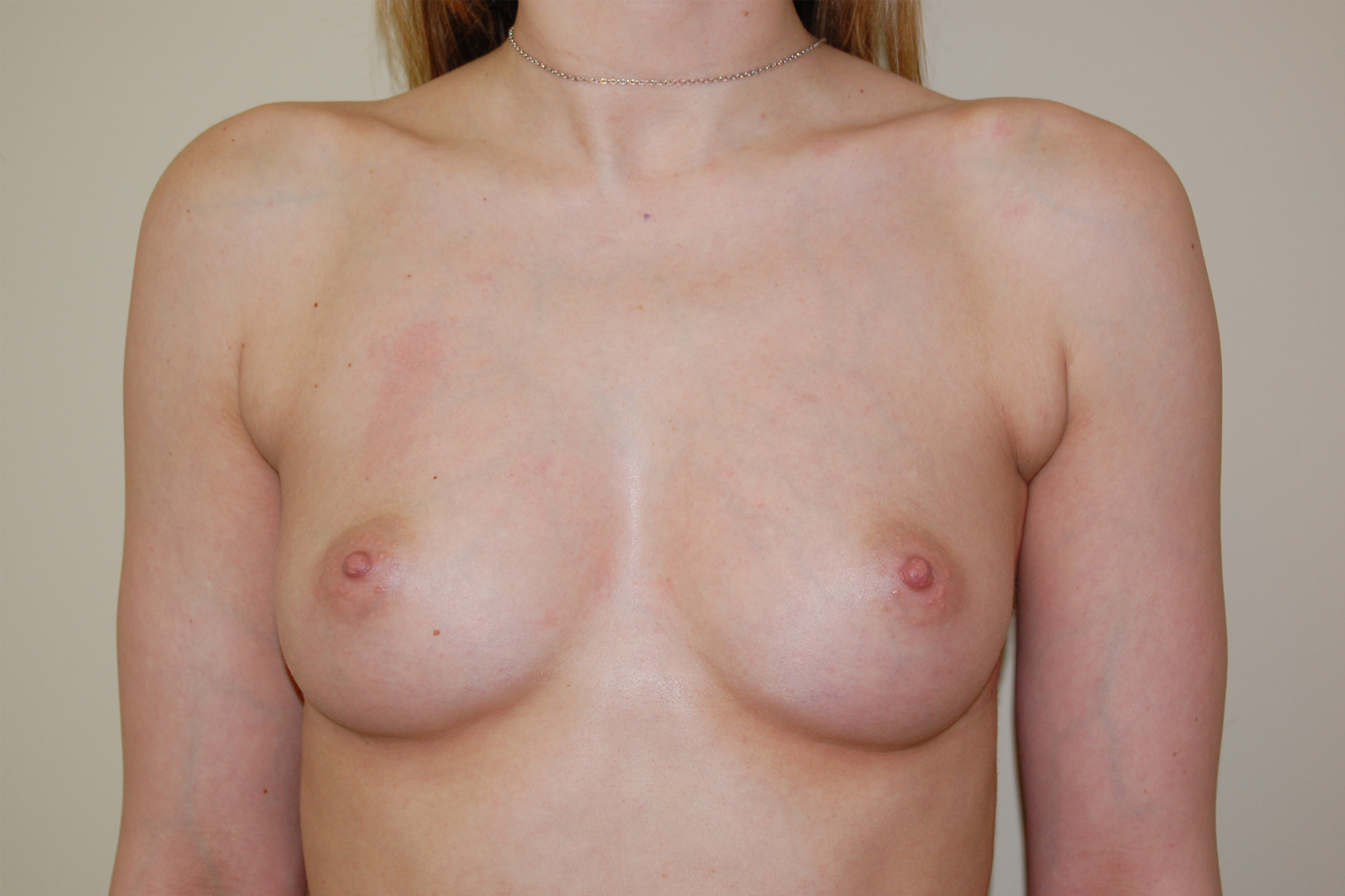 Procedure before and after - before