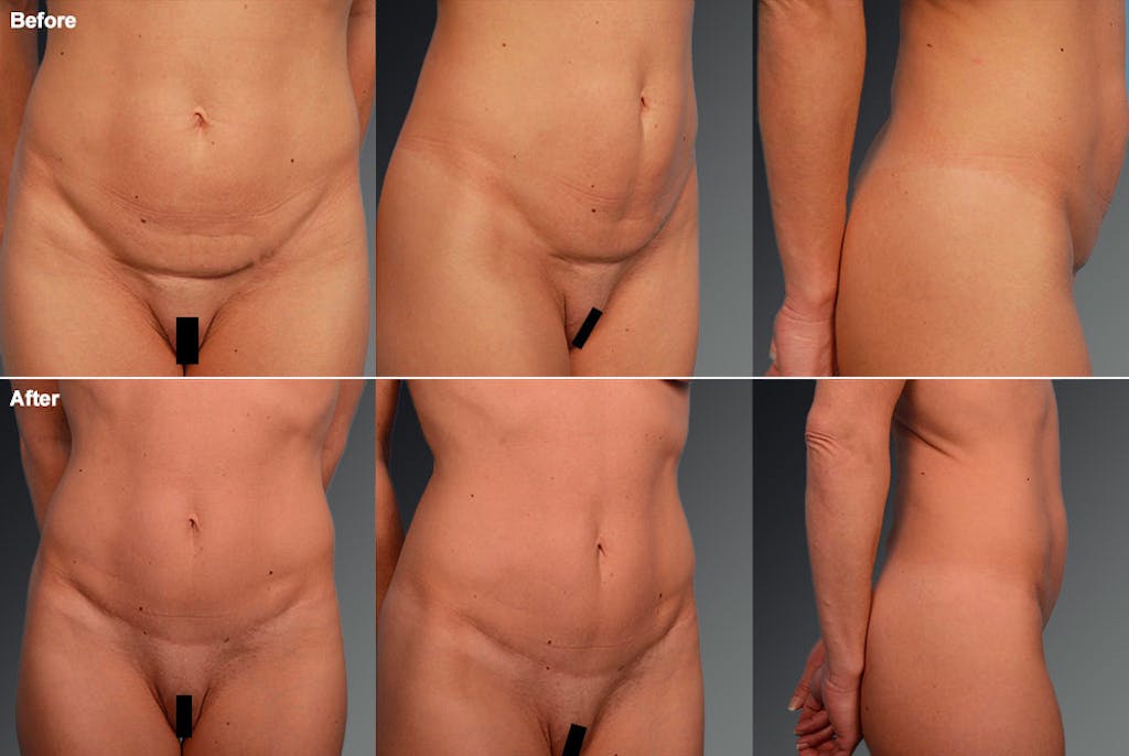 Mini Tummy Tuck before and after - after