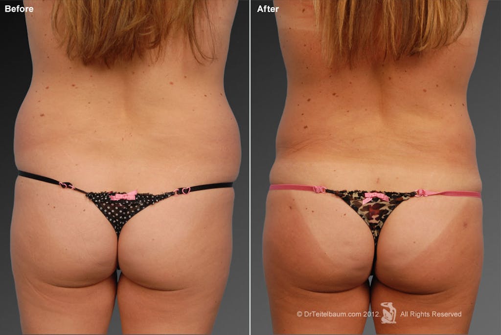 Liposuction before and after - after
