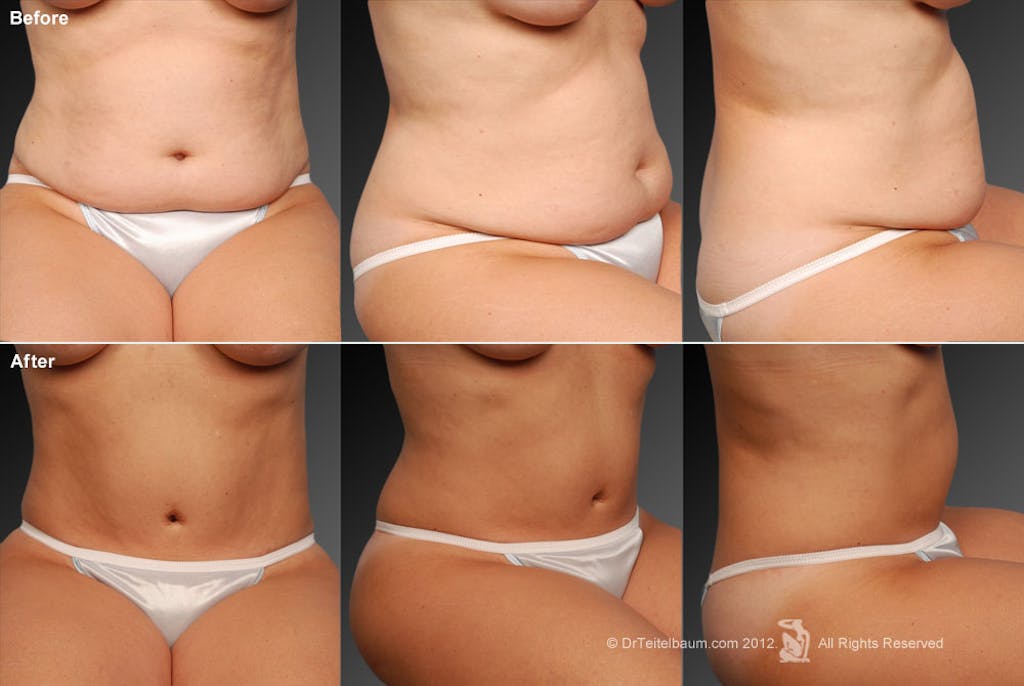 Mini Tummy Tuck before and after - after