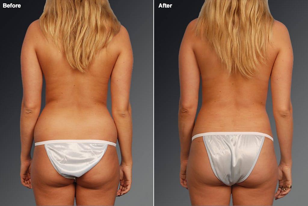 Liposuction before and after - after