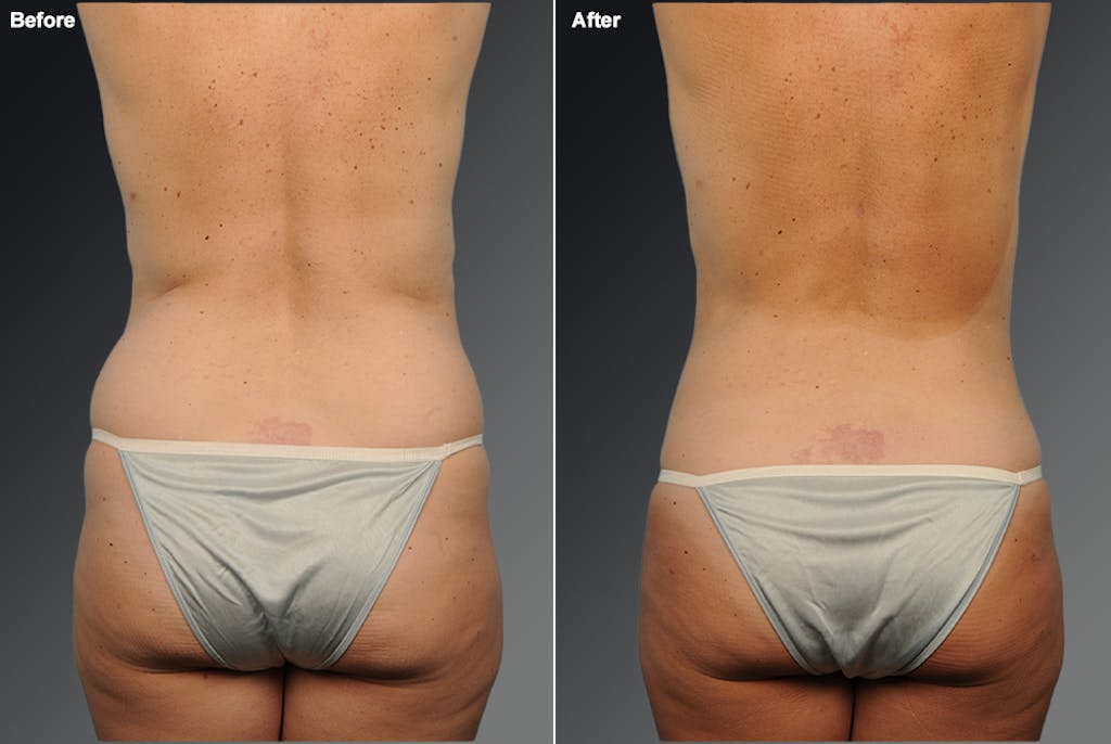Liposuction by Dr. Steven Teitelbaum — before and after