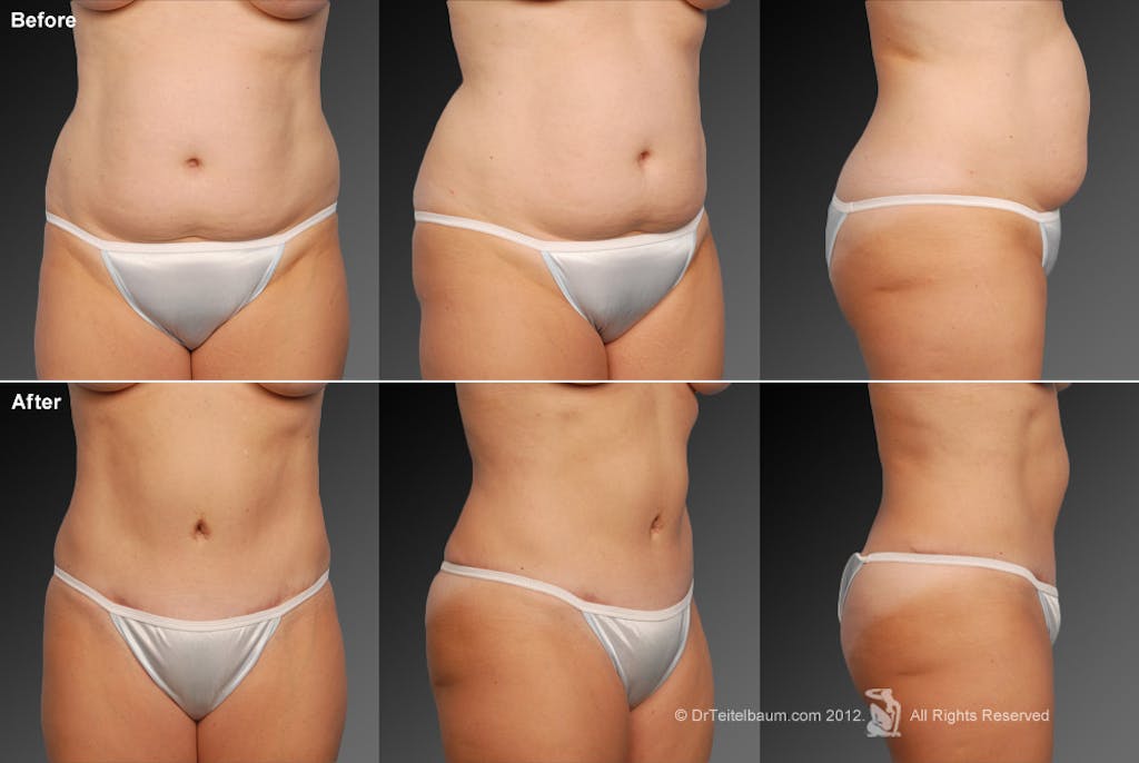Mini Tummy Tuck by Dr. Steven Teitelbaum — before and after