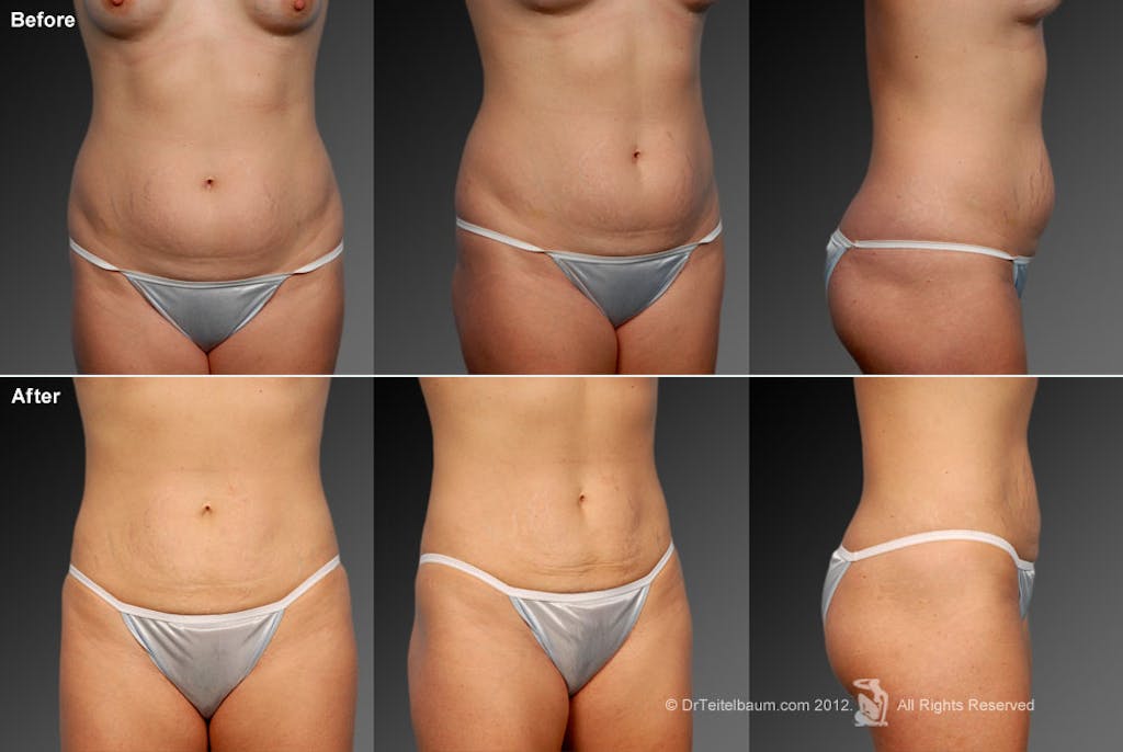 Mini Tummy Tuck by Dr. Steven Teitelbaum — before and after