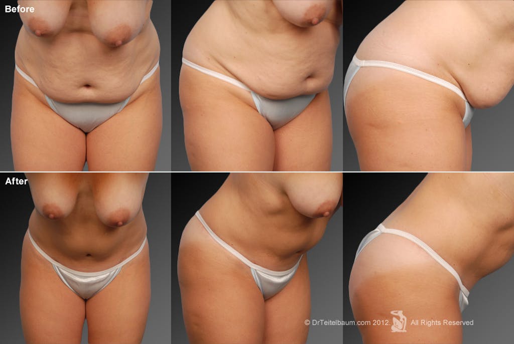 Mini Tummy Tuck by Dr. Steven Teitelbaum — before and after