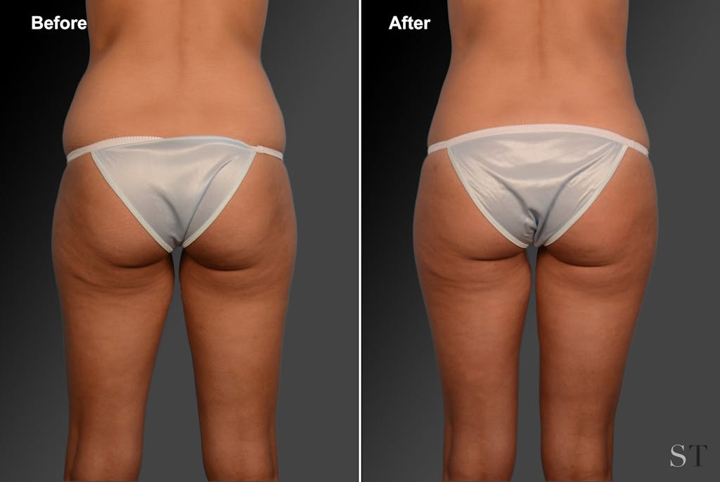 Liposuction by Dr. Steven Teitelbaum — before and after
